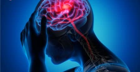Tai biến mạch máu não - Nguyên nhân và dấu hiệu nhận biết ban đầu - Hình 1