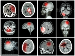 Đột quỵ chảy máu não: Triệu chứng, chẩn đoán và cách điều trị