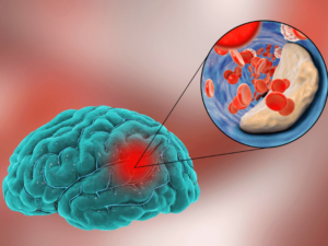 Đột quỵ do dị dạng mạch máu não: Nguyên nhân và các biến chứng