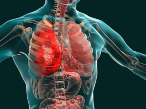 Suy tim phải là gì? Những yếu tố nguy cơ và cách điều trị