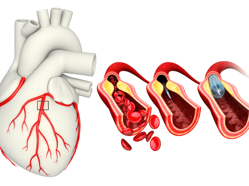 Bệnh thiếu máu cơ tim: Nguy hiểm và cách phòng ngừa