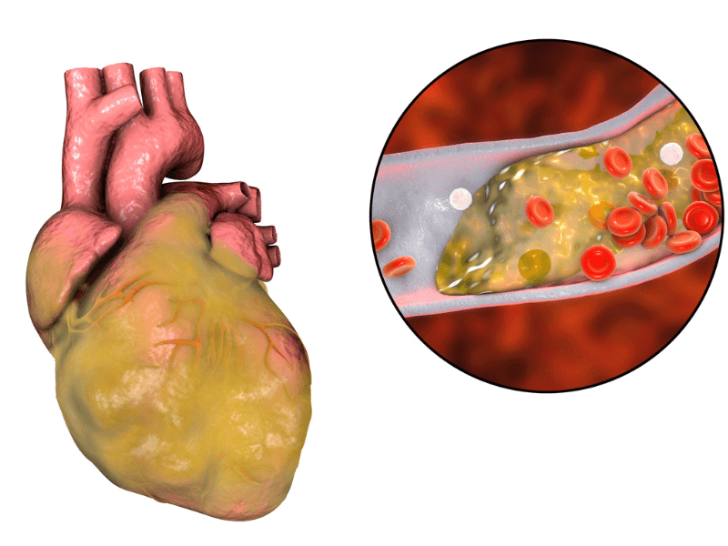 Nhồi máu cơ tim Type 2: Phát hiện sớm và cách điều trị hiệu quả