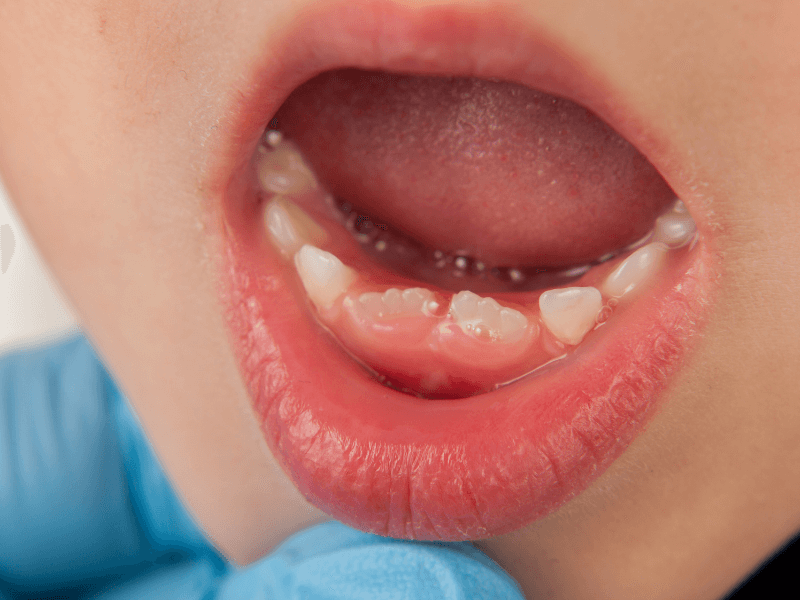 Nguyên nhân và cách xử lý khi trẻ bị sốt nhưng không ho sổ mũi