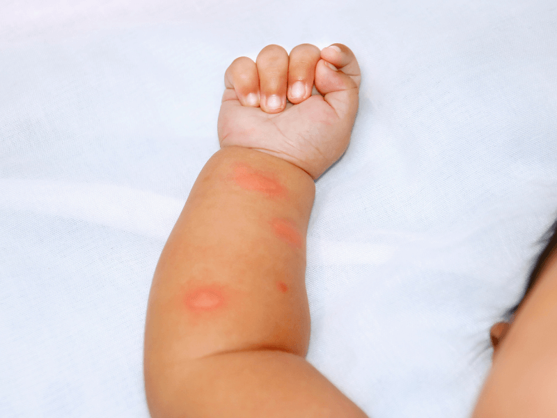 Các dạng sốt virus thường gặp ở trẻ em và cách xử trí