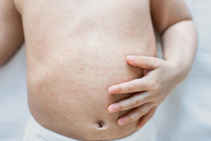 Dấu hiệu bị sốt xuất huyết: Biết để phòng tránh và điều trị tốt nhất