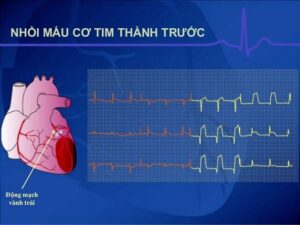 Vùng nhồi máu cơ tim: Tại sao bạn nên chú ý và cách phòng tránh