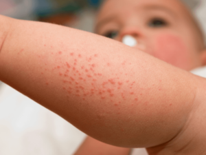 Cách nhận biết sốt xuất huyết nổi ban đỏ ở trẻ em và người lớn