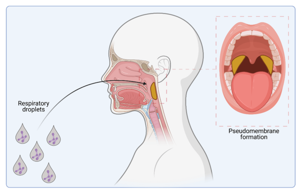 Bệnh bạch hầu lây qua đường nào?