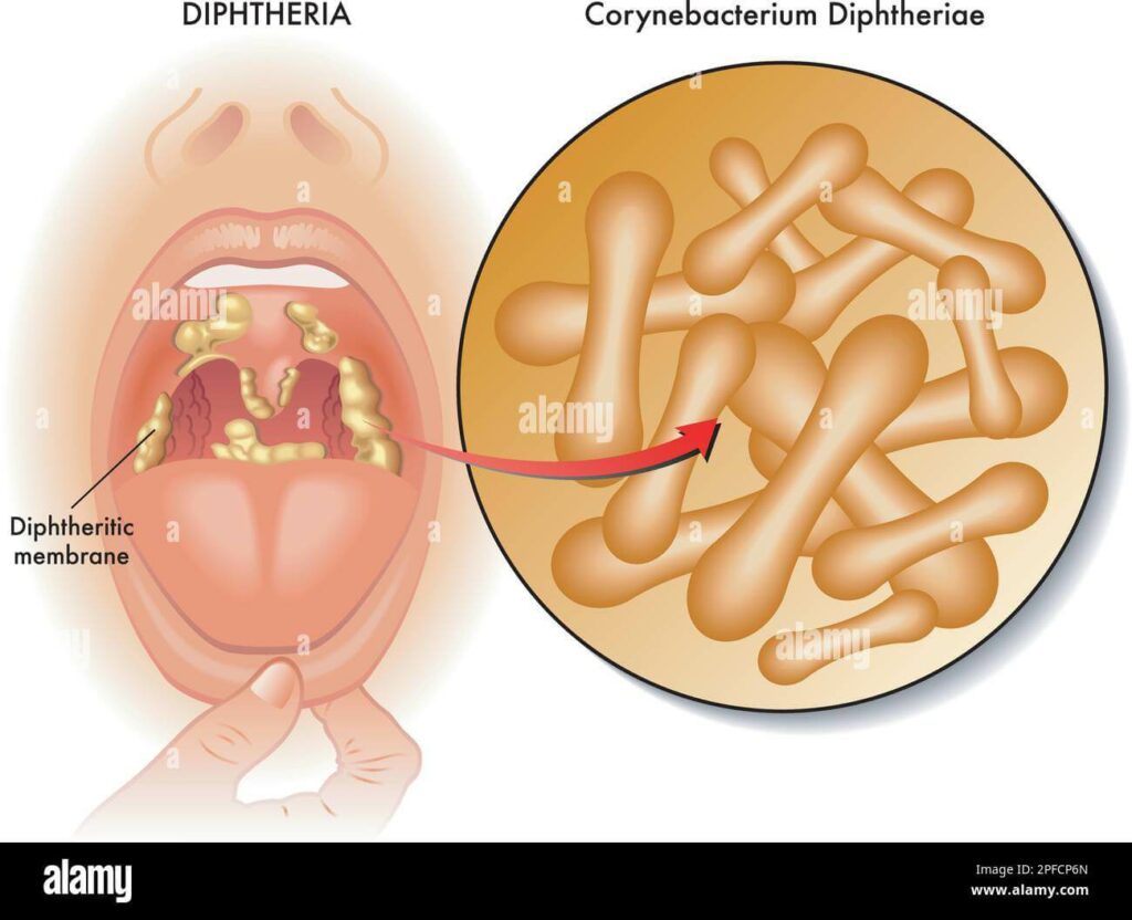 Bệnh bạch hầu lây qua đường nào? Nguyên nhân và biện pháp phòng ngừa -  Microlife