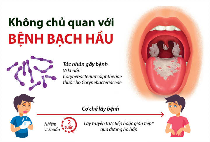 Triệu chứng bệnh bạch hầu: Nhận biết sớm để điều trị kịp thời - Microlife