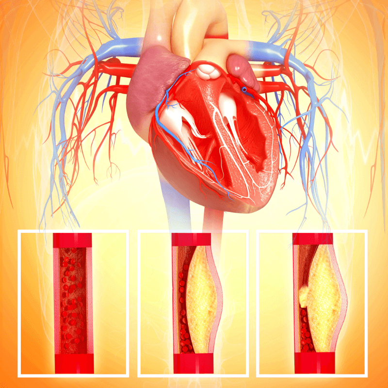 Rối loạn nhịp tim Atrial Fibrillation (AFib) và mối liên hệ mật thiết với đột quỵ