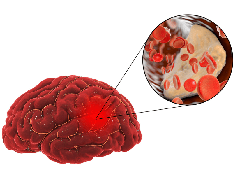 Đột quỵ do thiếu máu não: Hiểu rõ triệu chứng và phương pháp điều trị
